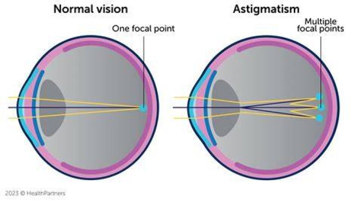 A Guide To How Astigmatism Lights Look Blog Eyebuydirect