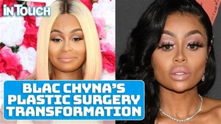 Blac Chyna&rsquo;s Plastic Surgery Transformation See Photos of Her Before