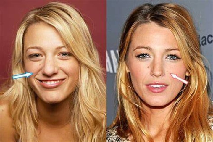 Blake Lively Plastic Surgery: A Transformation from Girl Next Door to Hollywood Bombshell 1 Blake Lively Plastic Surgery