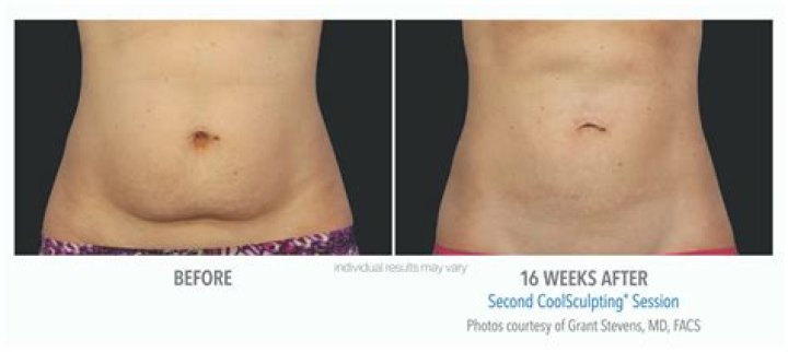 CoolSculpting Before and After Images Real Patient Results
