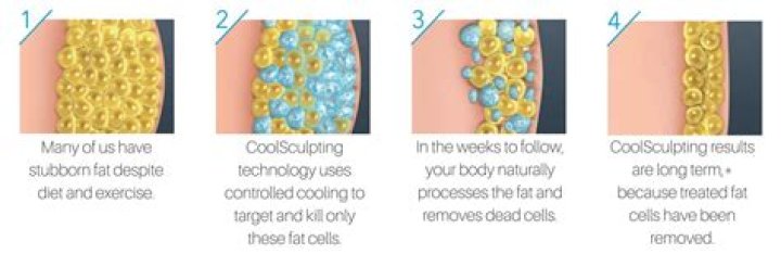 CoolSculpting Freeze away Fat Chatham, New Jersey