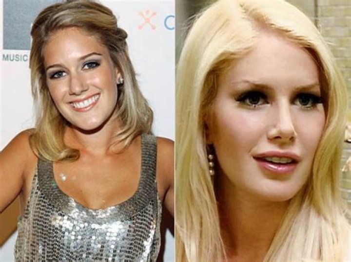 Heidi Montag Before and After Surgery: Navigating the Reality TV Star's Transformation 1 Heidi Montag Before and After Surgery