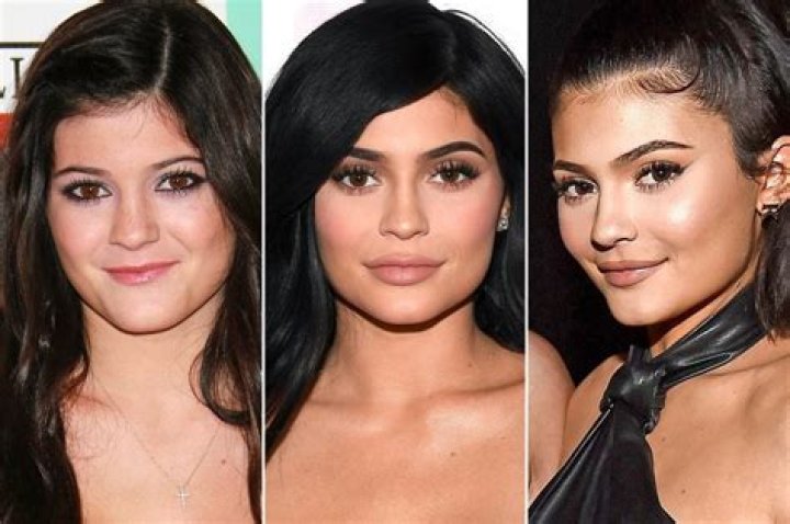 Hot Billionaire Kylie Genre has gone through Lip Plastic surgery again