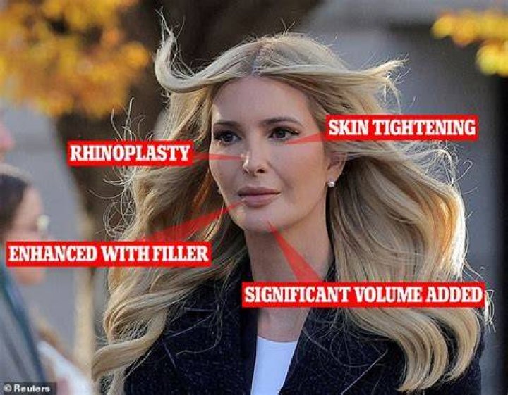 Has Ivanka Trump Had Plastic Surgery? Here’s What Experts Say 1 Ivanka Trump Had Plastic Surgery