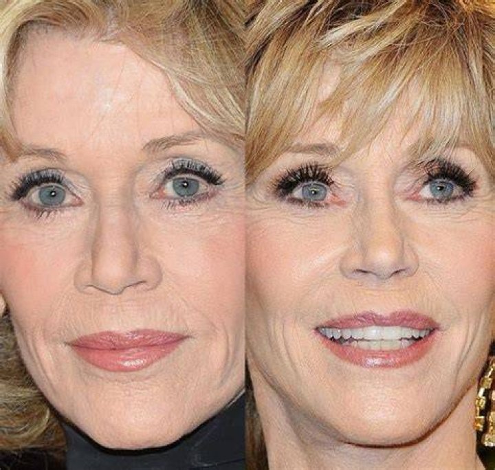 Jane Fonda Eyelid Surgery Jane fonda plastic surgery, Jane fonda
