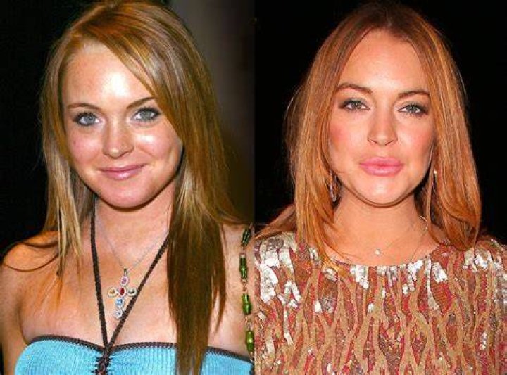 Lindsay Lohan from Celebs Who Deny Getting Plastic Surgery E! News