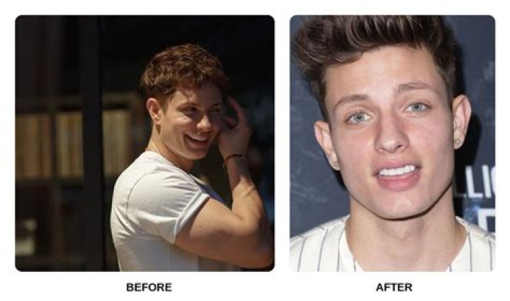 Matt Rife Teeth Before and After Venners Photos Are Adorable