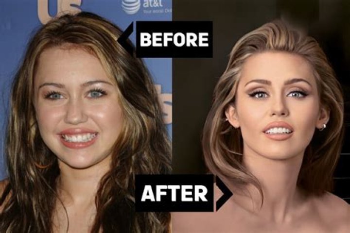 Miley Cyrus Before After Teeth ictendavraniyor