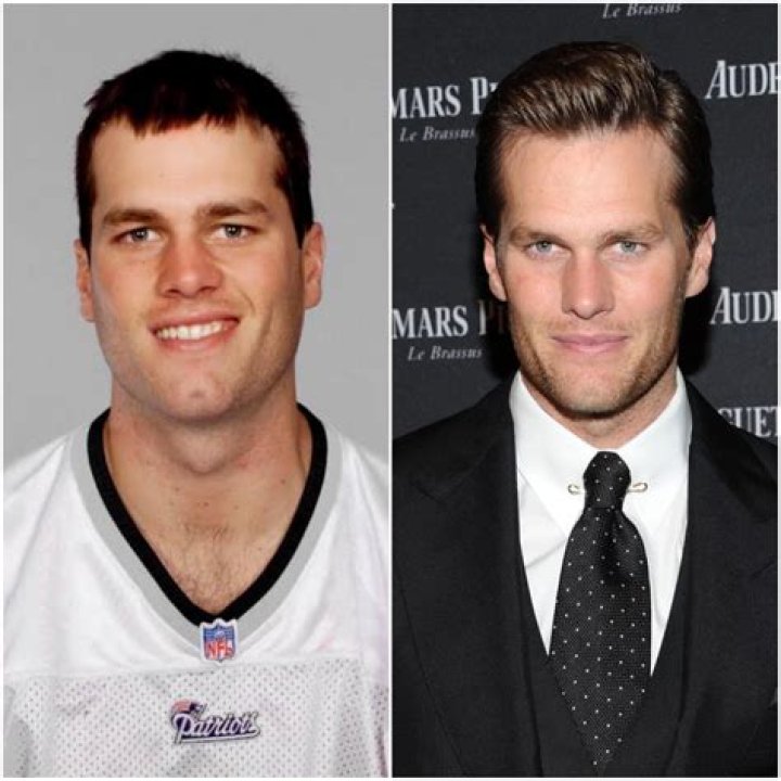 Tom Brady hair and face Open Hair Loss Topics Hair Restoration