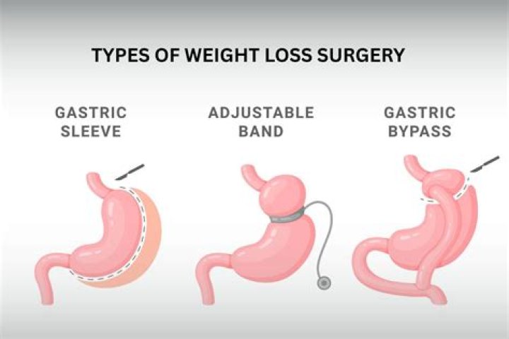Weight Loss Surgery, Gypsy-lupone