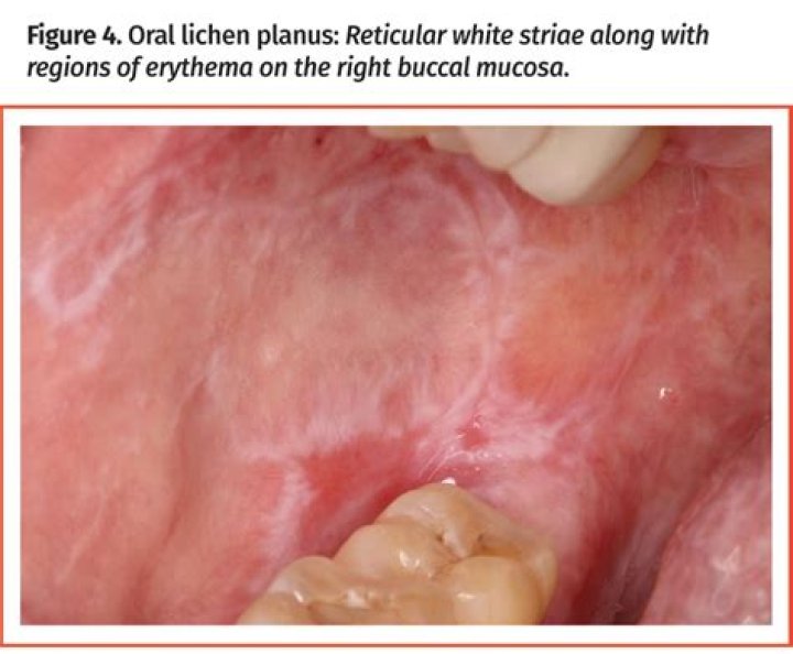 White Bumps On Buccal Mucosa